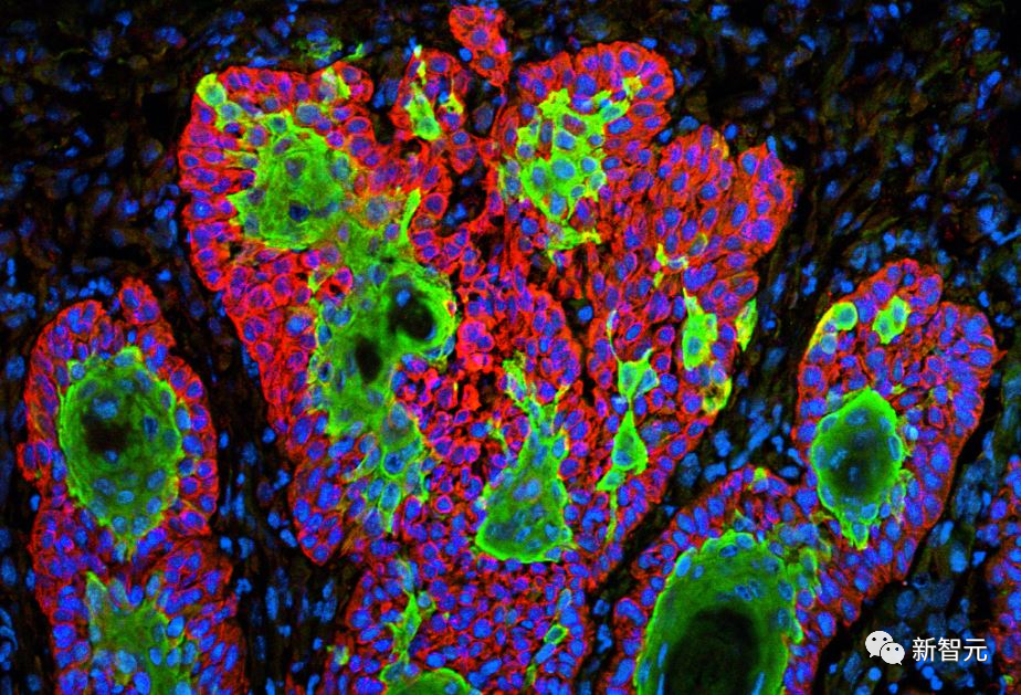 Nature子刊:AI算法破解癌细胞基因特征,准确率可达99%!