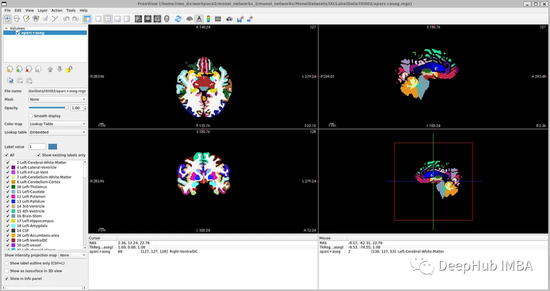 医学图像的深度学习的完整代码示例:使用Pytorch对MRI脑扫描的图像进行分割