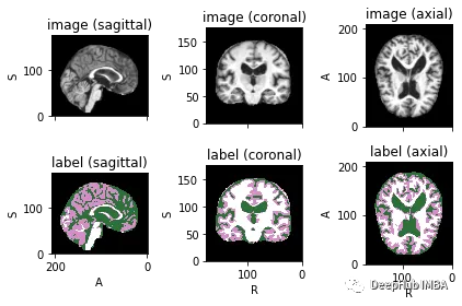 医学图像的深度学习的完整代码示例:使用Pytorch对MRI脑扫描的图像进行分割