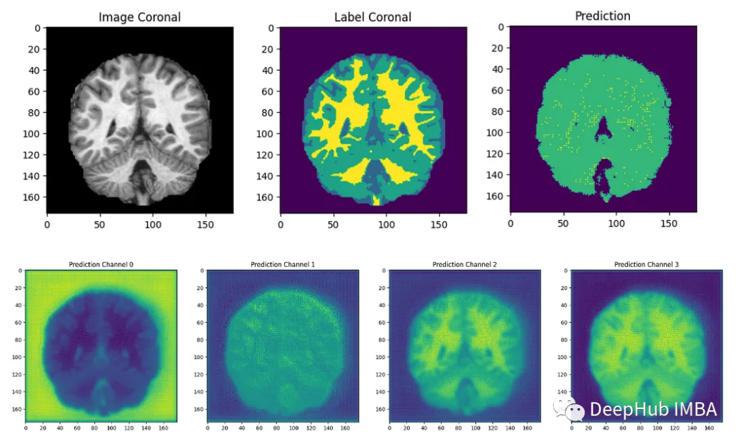 医学图像的深度学习的完整代码示例:使用Pytorch对MRI脑扫描的图像进行分割