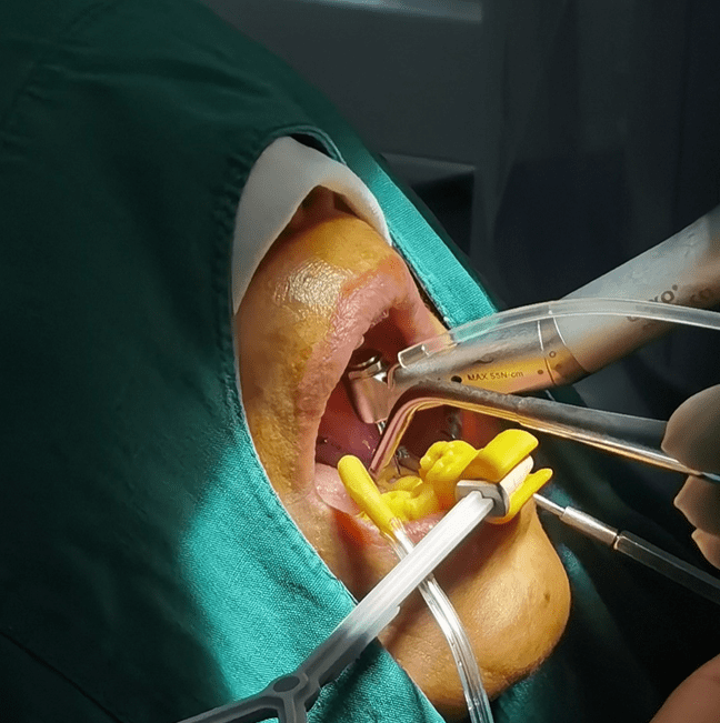 【视频】机器人能种牙!痛感减少,精准提升10倍,你接受吗?