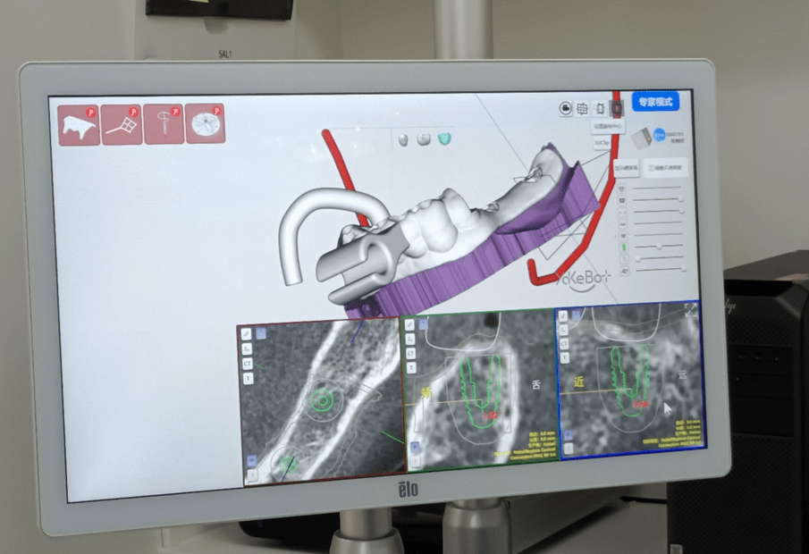 【视频】机器人能种牙!痛感减少,精准提升10倍,你接受吗?