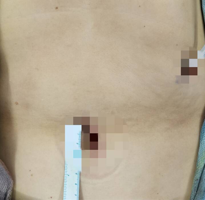 山东第一医科大学附属省立医院成功实施全球首例完全单孔机器人全胃切除手术