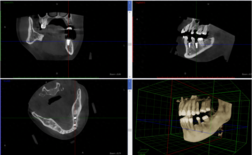 机器人牙种植，将给种植带来哪些技术变革？