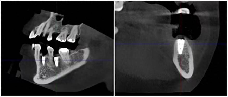 机器人牙种植，将给种植带来哪些技术变革？