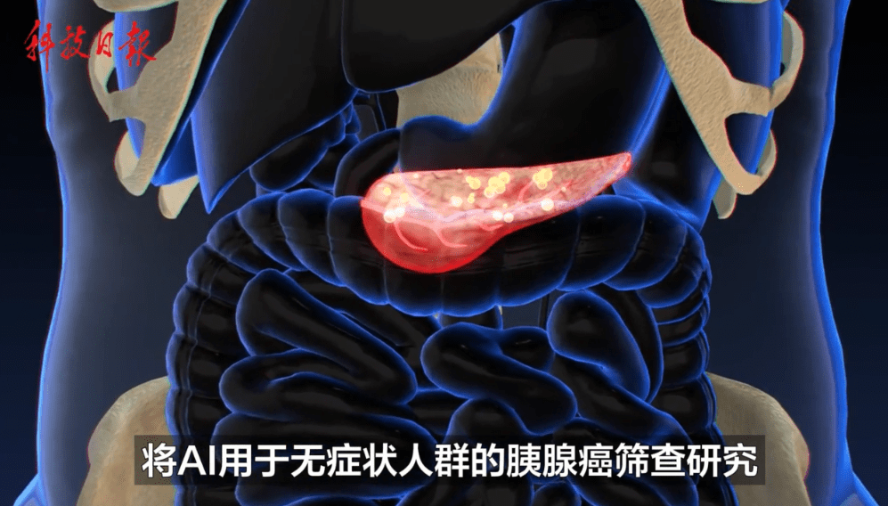 科技新突破!AI加持CT,人类首次拥有大规模筛查早期胰腺癌手段