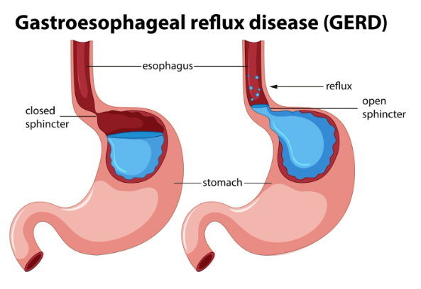 苹果手表可能有助于GERD患者改善睡眠，阿姆斯特丹大学研究发现