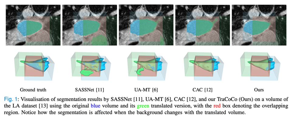 TMI2024 | 阿大、同济等提出TraCoCo，用于3D医学图像半监督分割