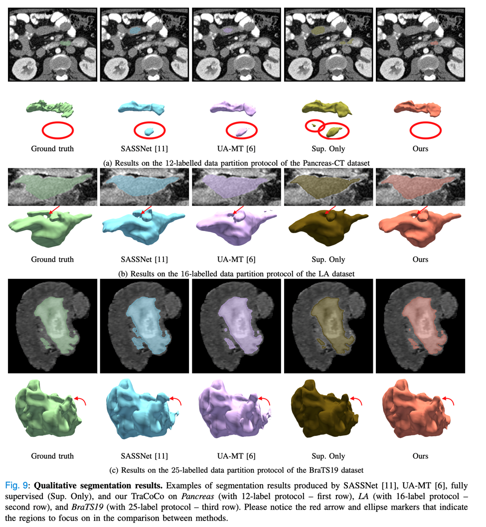 TMI2024 | 阿大、同济等提出TraCoCo，用于3D医学图像半监督分割