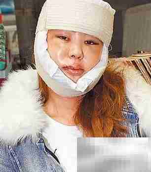 面部悬吊提升恢复时间