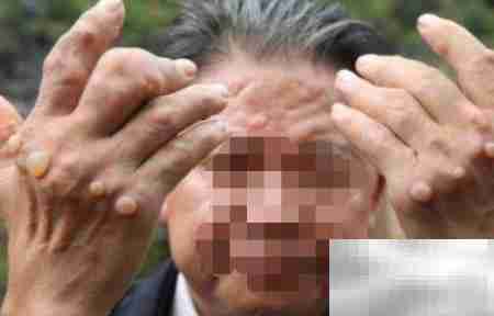 痛风高发人群有哪些?