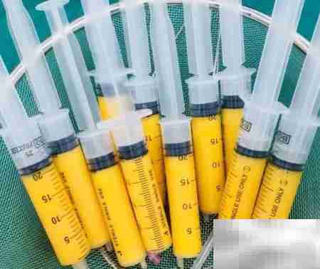 自体脂肪填充致脸歪？