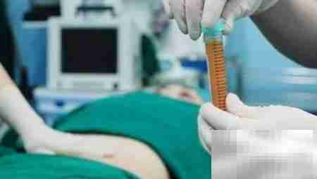 自体脂肪填充致脸歪？