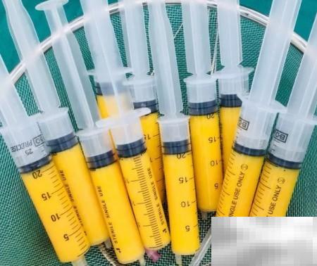 自体脂肪填充脸歪原因揭秘