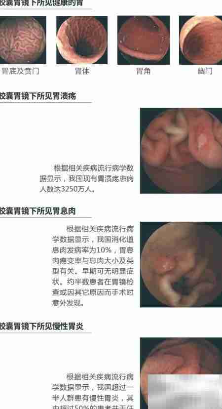 胶囊胃镜的优势解析