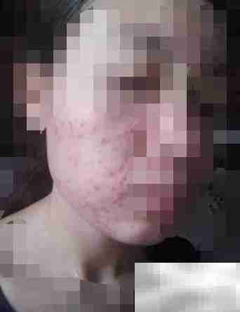 超声刀副作用三步解析